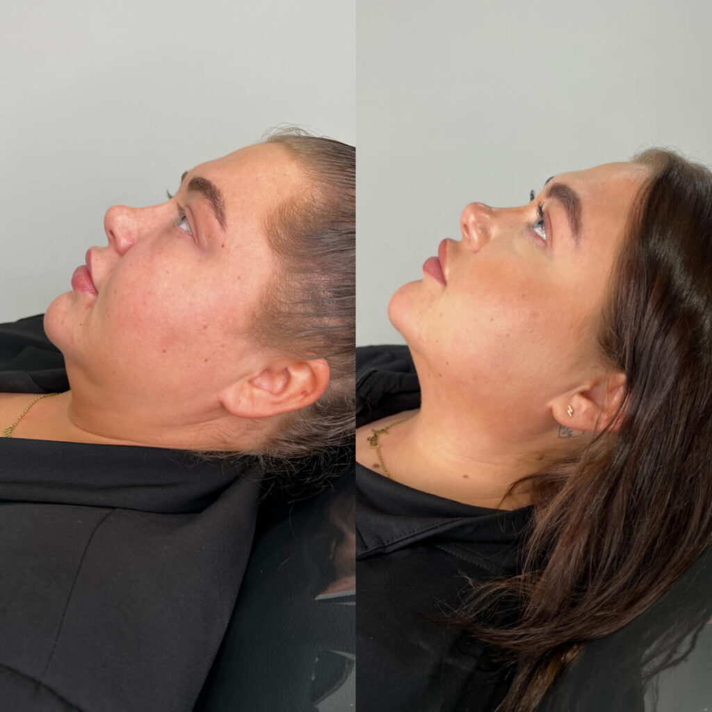 Fat Dissolving | Faces By Bae | London Aesthetics | Award Winning
