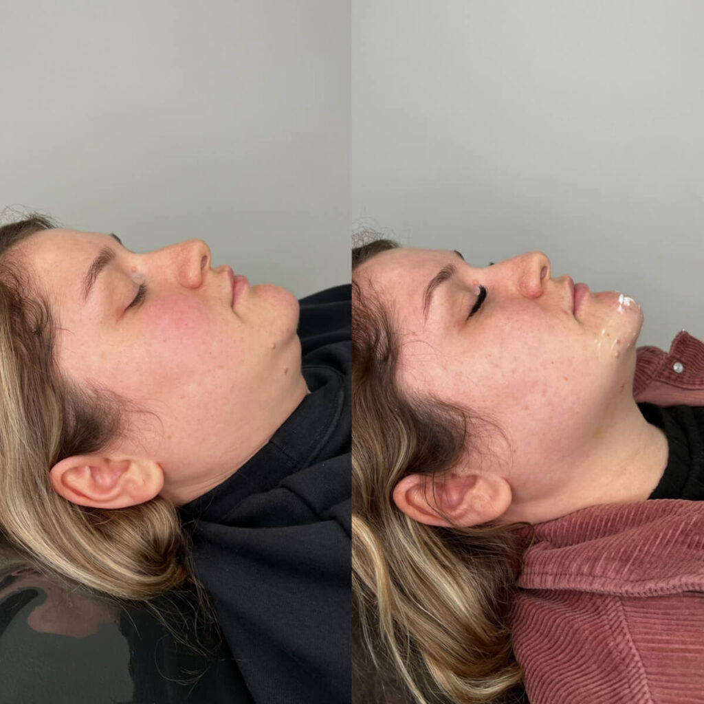 Fat Dissolving | Faces By Bae | London Aesthetics | Award Winning
