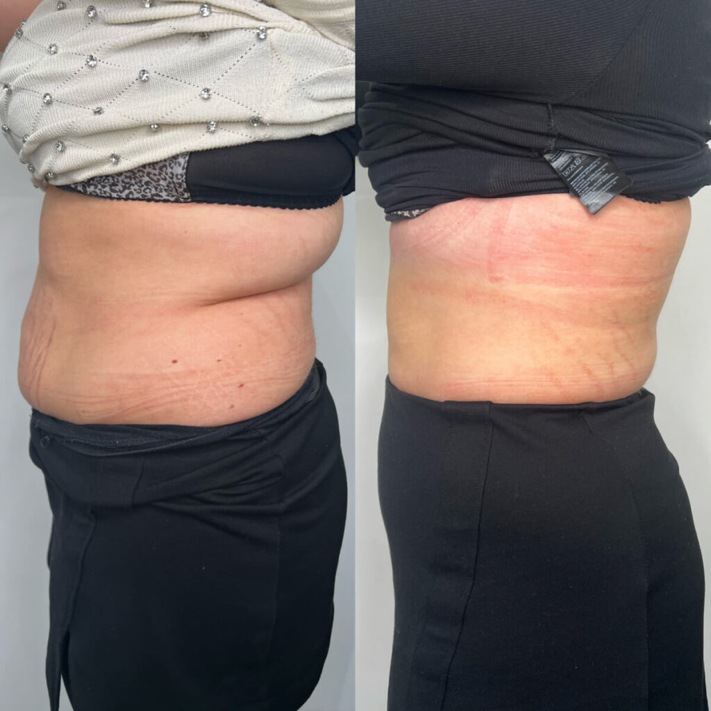 Fat Dissolving | Faces By Bae | London Aesthetics | Award Winning