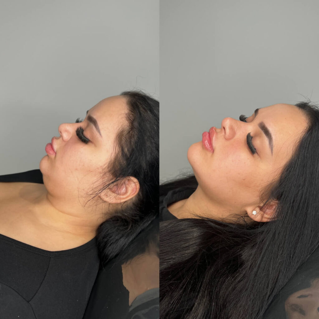 Fat Dissolving | Faces By Bae | London Aesthetics | Award Winning