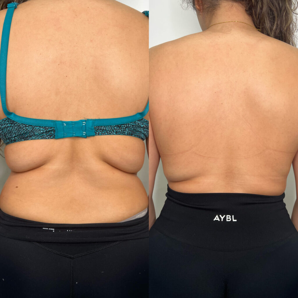 Fat Dissolving | Faces By Bae | London Aesthetics | Award Winning
