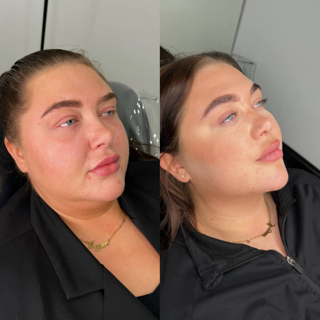 Fat Dissolving | Faces By Bae | London Aesthetics | Award Winning