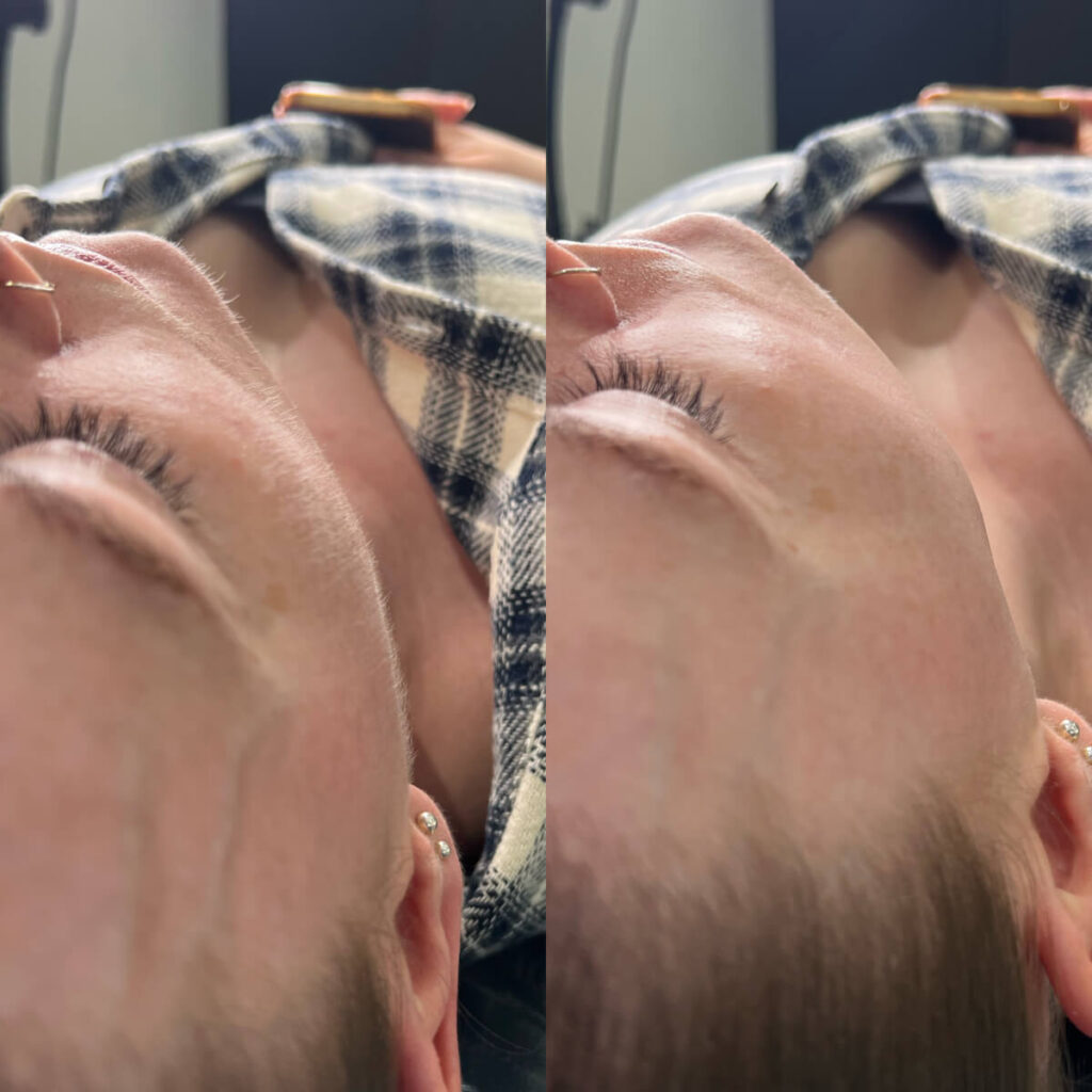 luxury dermaplaning