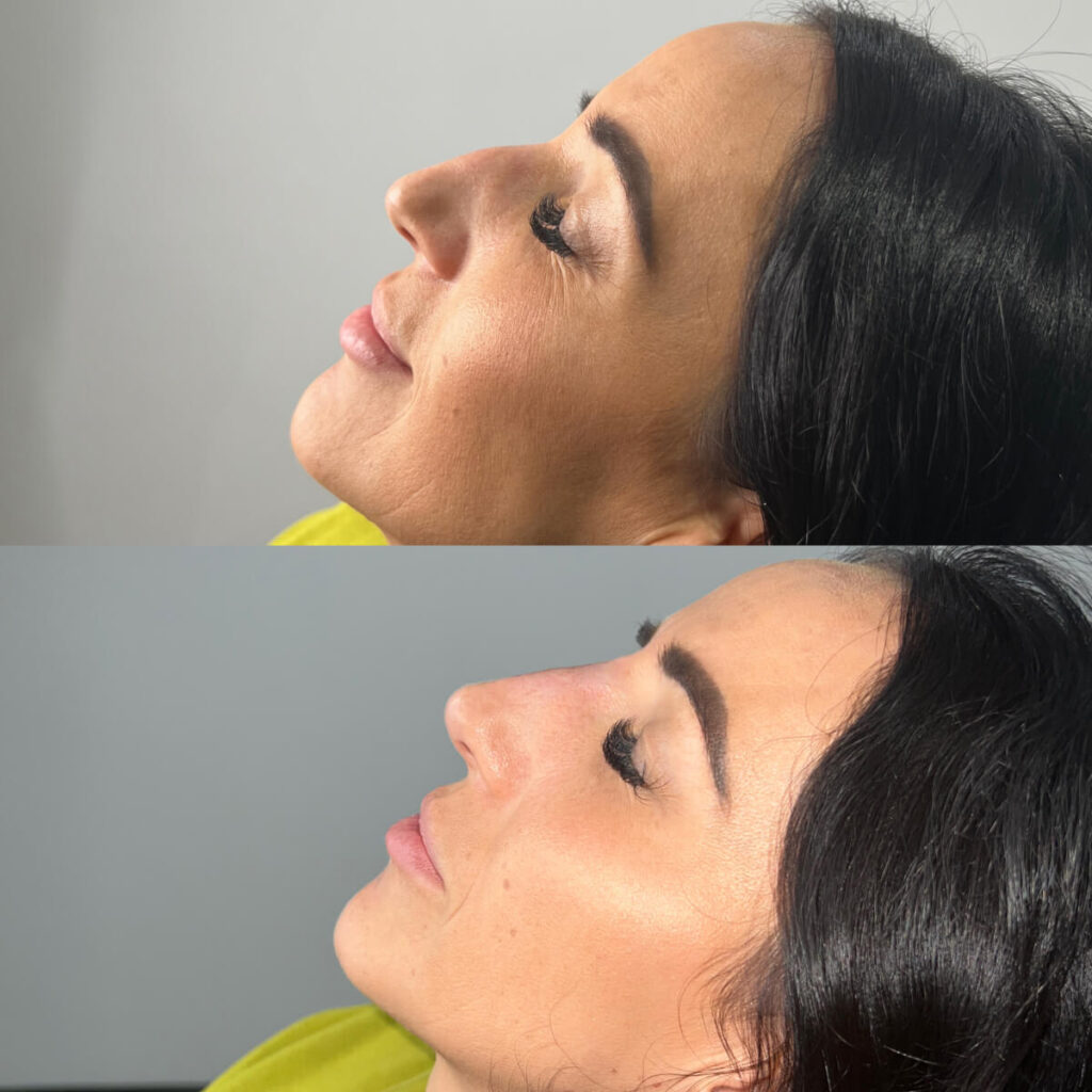 Non-Surgical Rhinoplasty | Faces By Bae | London Aesthetics | Award Winning