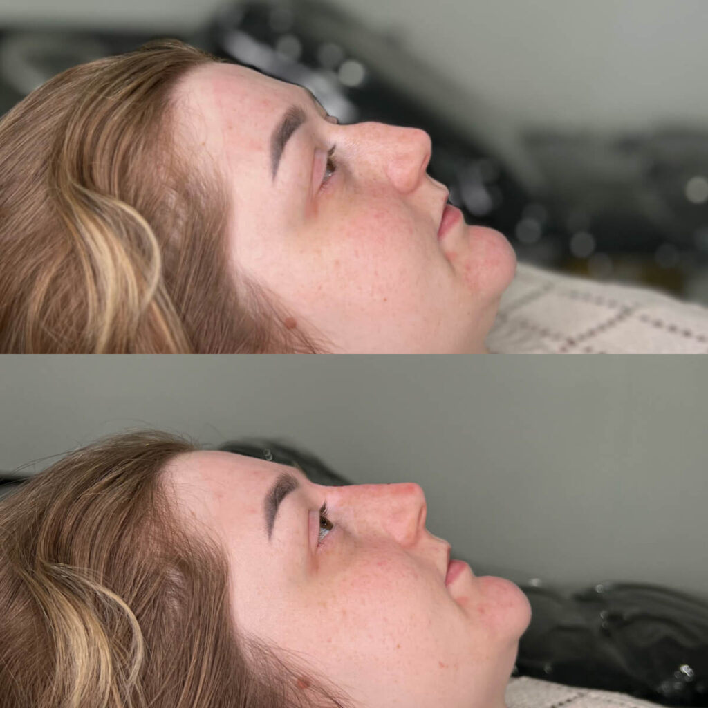 Non-Surgical Rhinoplasty | Faces By Bae | London Aesthetics | Award Winning