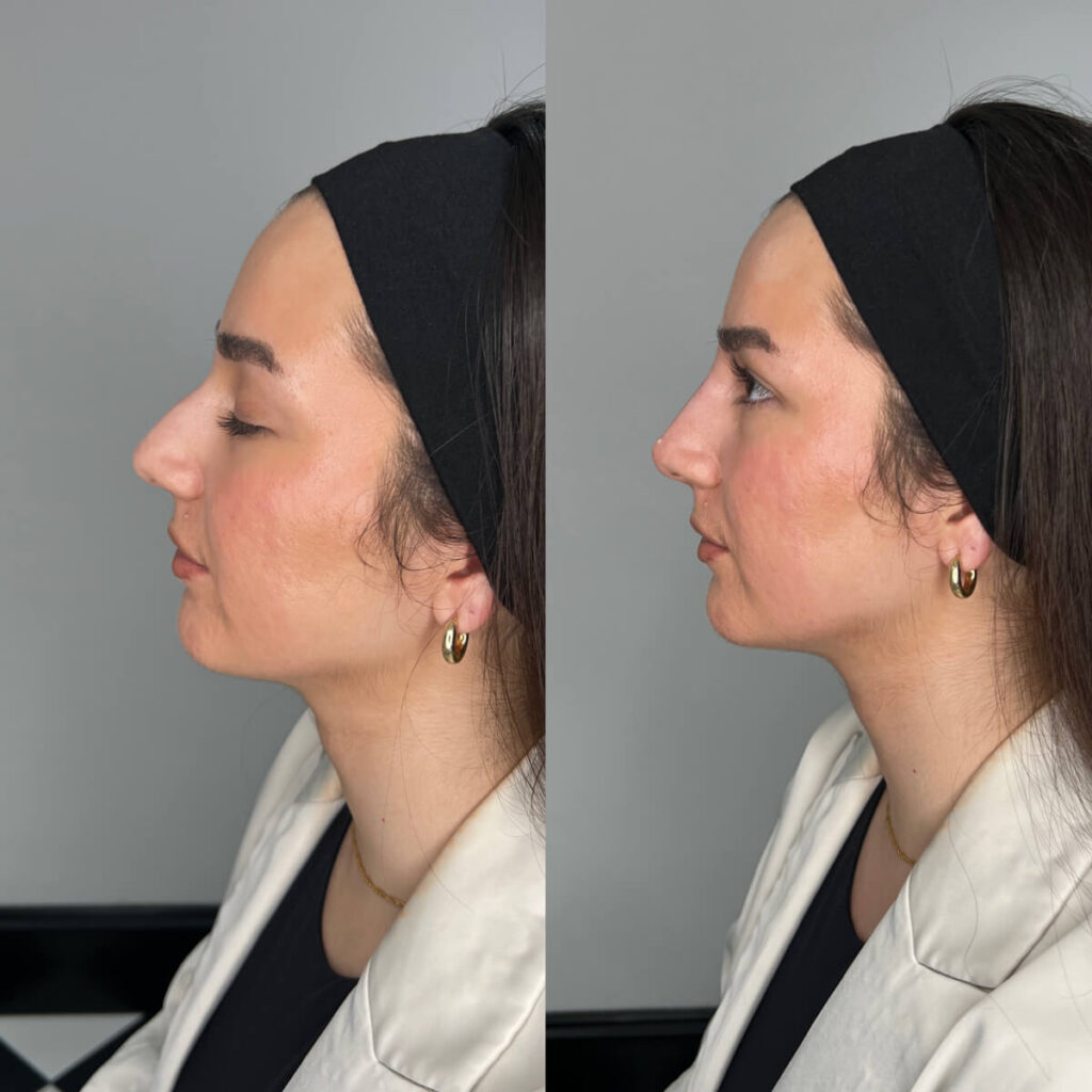 Non-Surgical Rhinoplasty | Faces By Bae | London Aesthetics | Award Winning