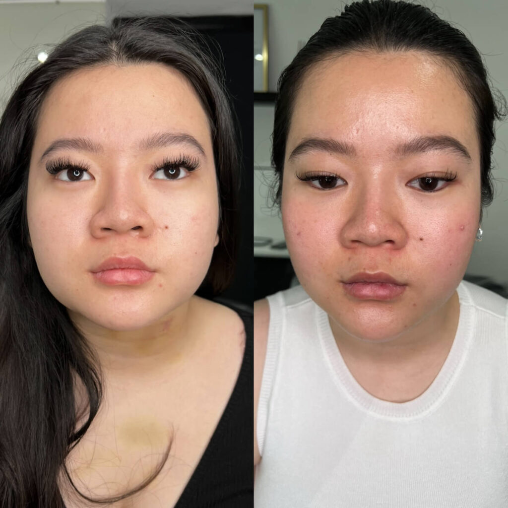 Masseter jawline slimming Botox