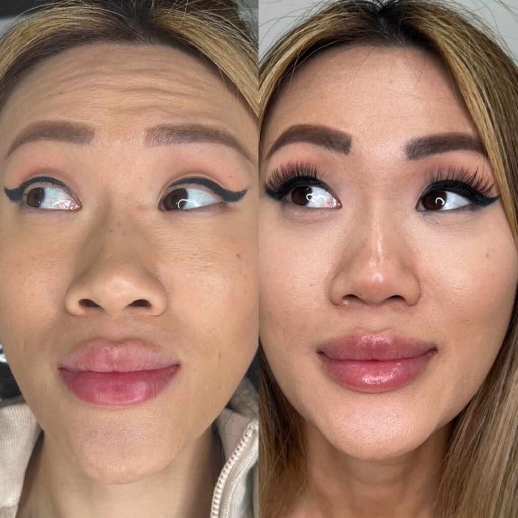 nostril flare reduction treatment