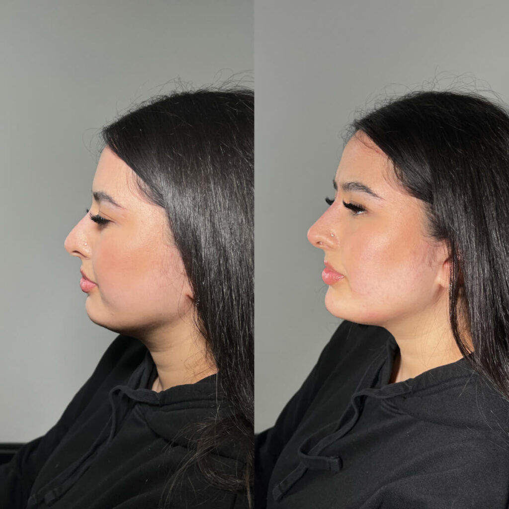 Non-Surgical Rhinoplasty | Faces By Bae | London Aesthetics | Award Winning