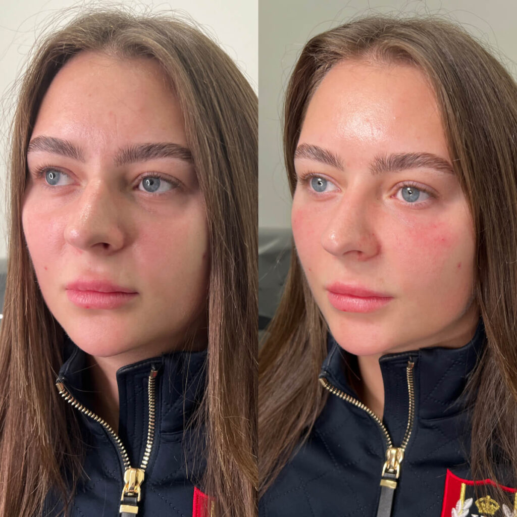 tear trough filler