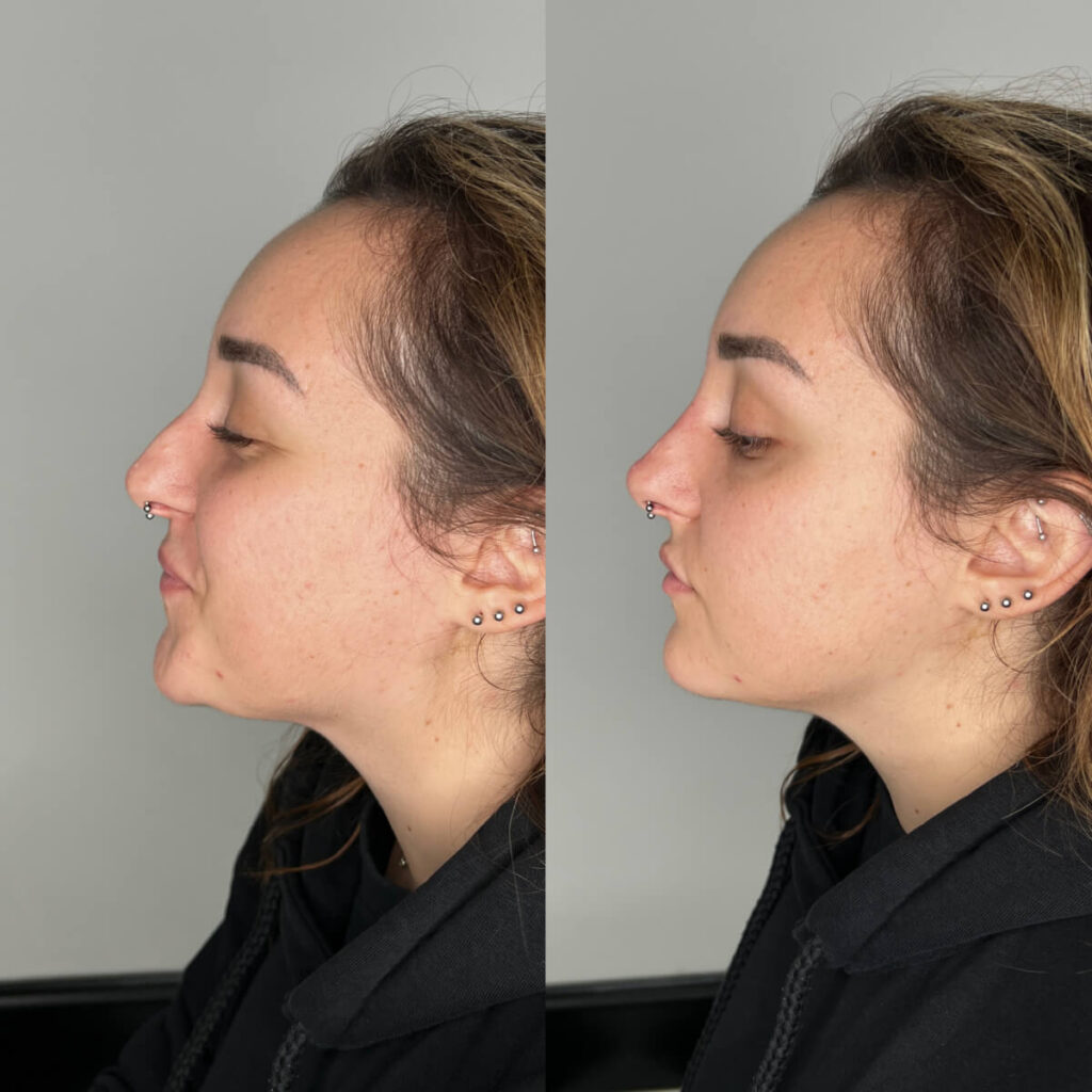 Non-Surgical Rhinoplasty | Faces By Bae | London Aesthetics | Award Winning