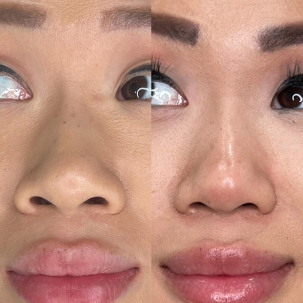 nostril flare reduction treatment