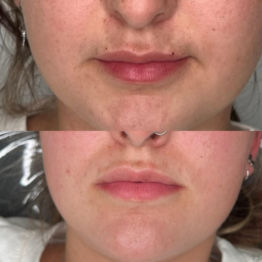 lip flip before and after
