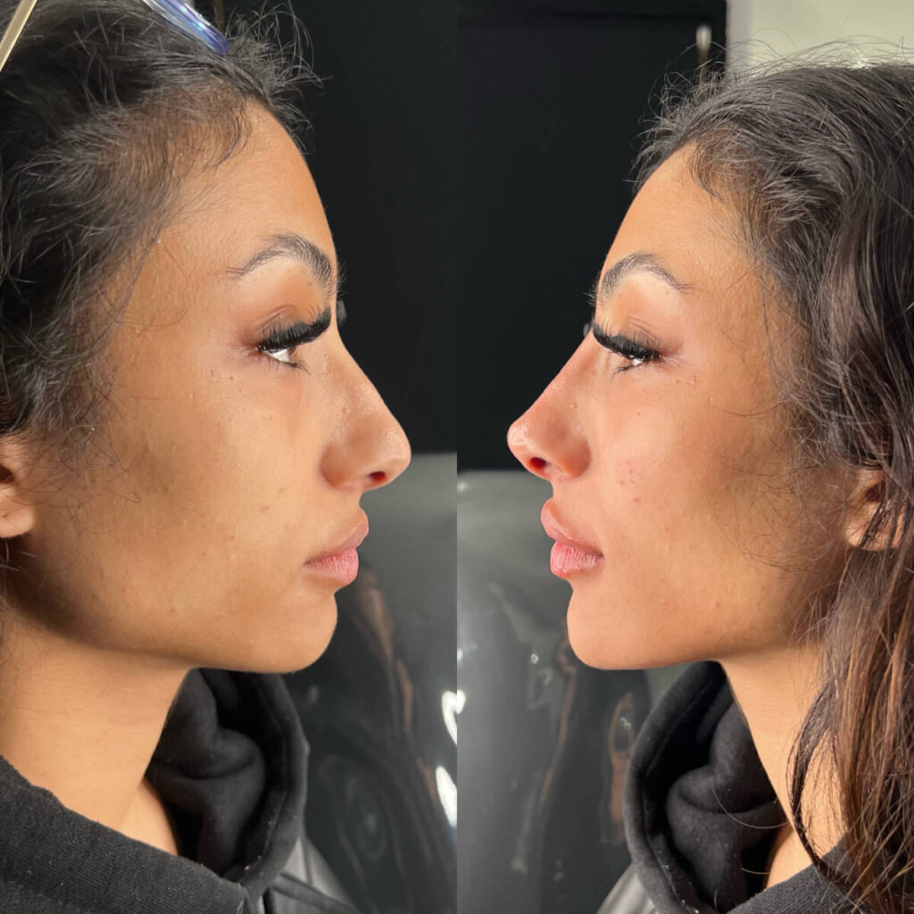 Non-Surgical Rhinoplasty | Faces By Bae | London Aesthetics | Award Winning