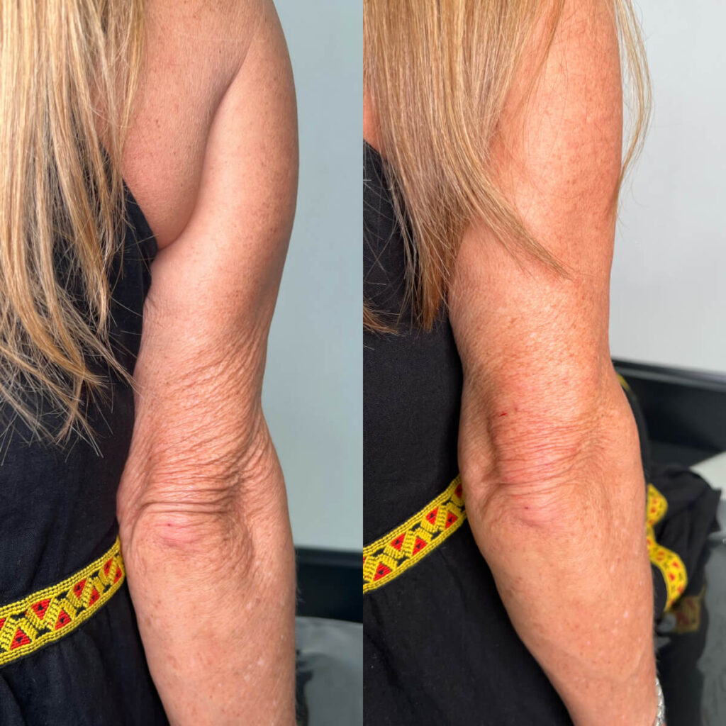 Profhilo Skin Booster