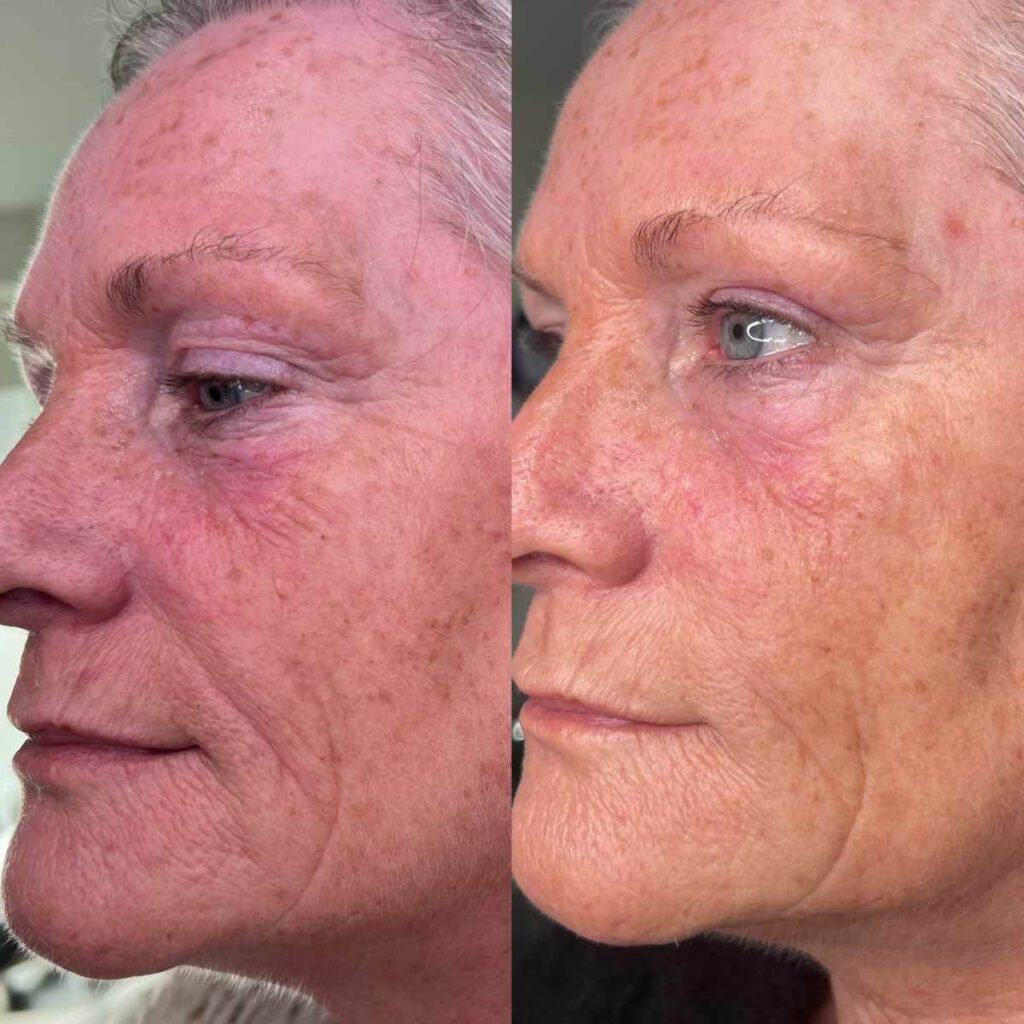 Profhilo Skin Booster