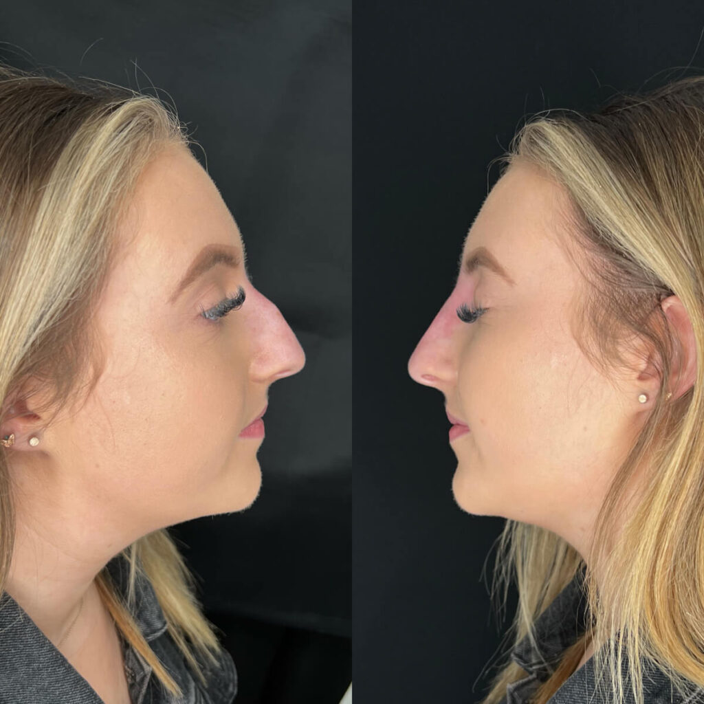 Non-Surgical Rhinoplasty | Faces By Bae | London Aesthetics | Award Winning