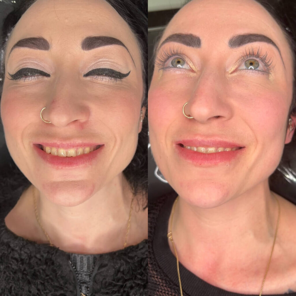 lip flip before and after