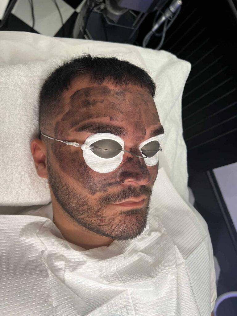 Laser Carbon Facial