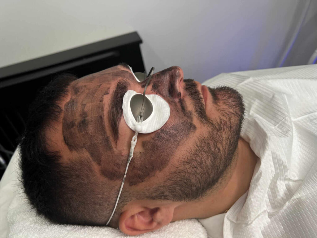 Laser Carbon Facial