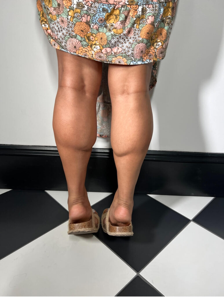 Calf Slimming | Faces By Bae | London Aesthetics | Award Winning
