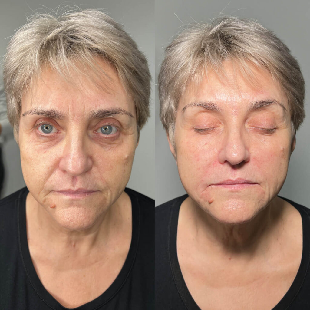 Nasolabial fold filler