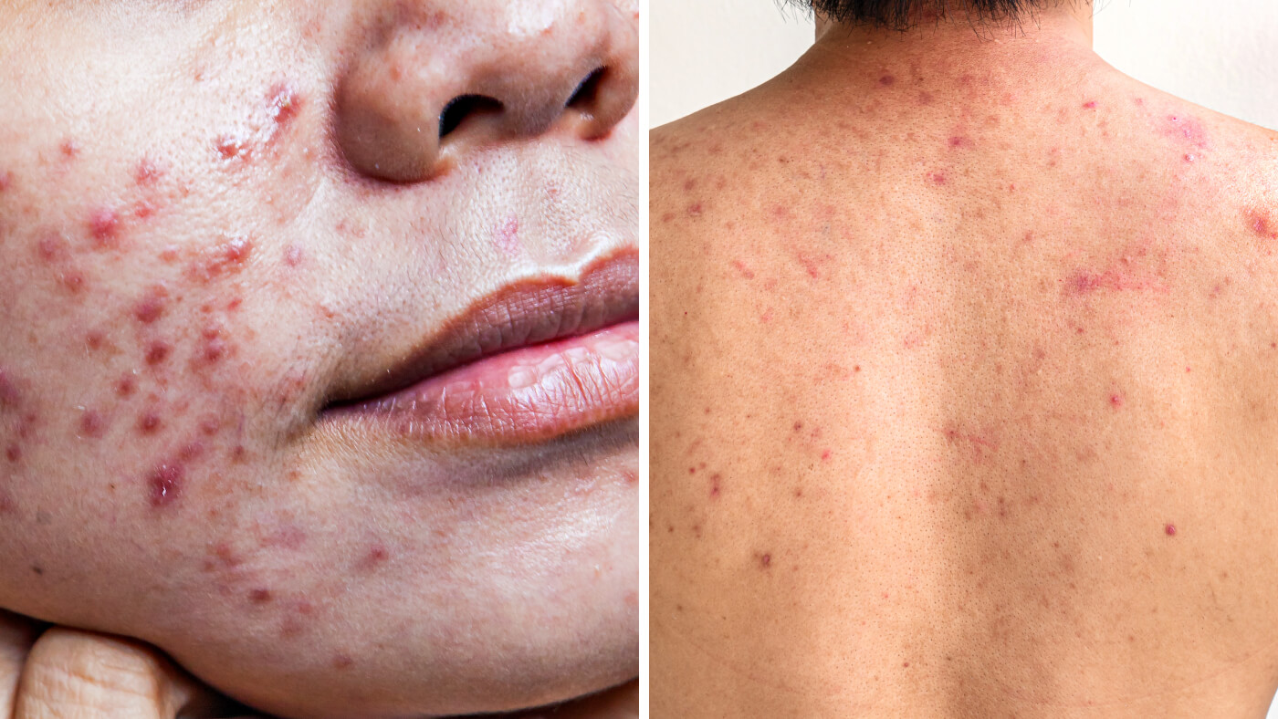 acne scars on face and back