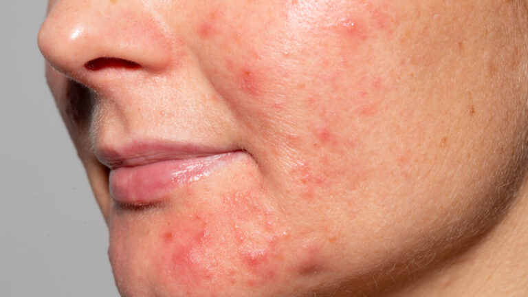 active acne