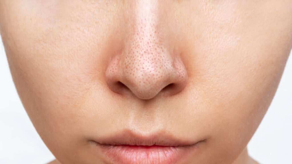 blackhead treatment