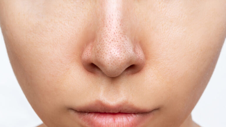 blackhead treatment