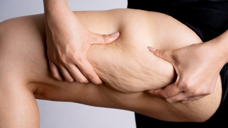 cellulite treatment