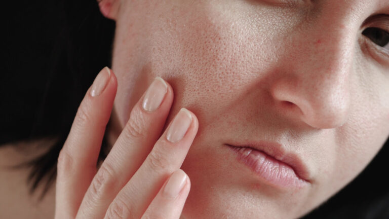 dull skin