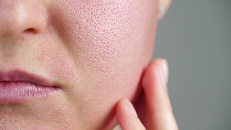 enlarged pores