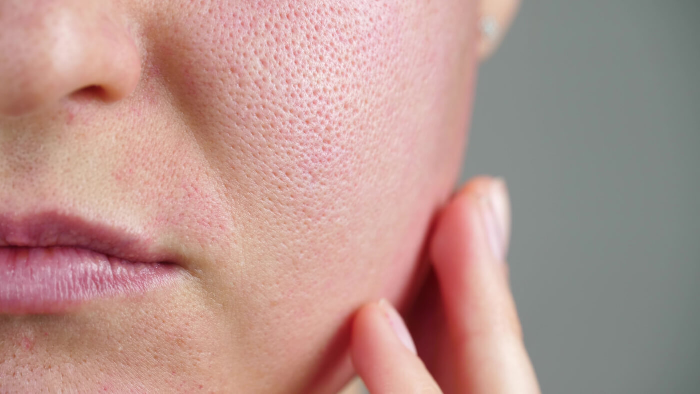 enlarged pores