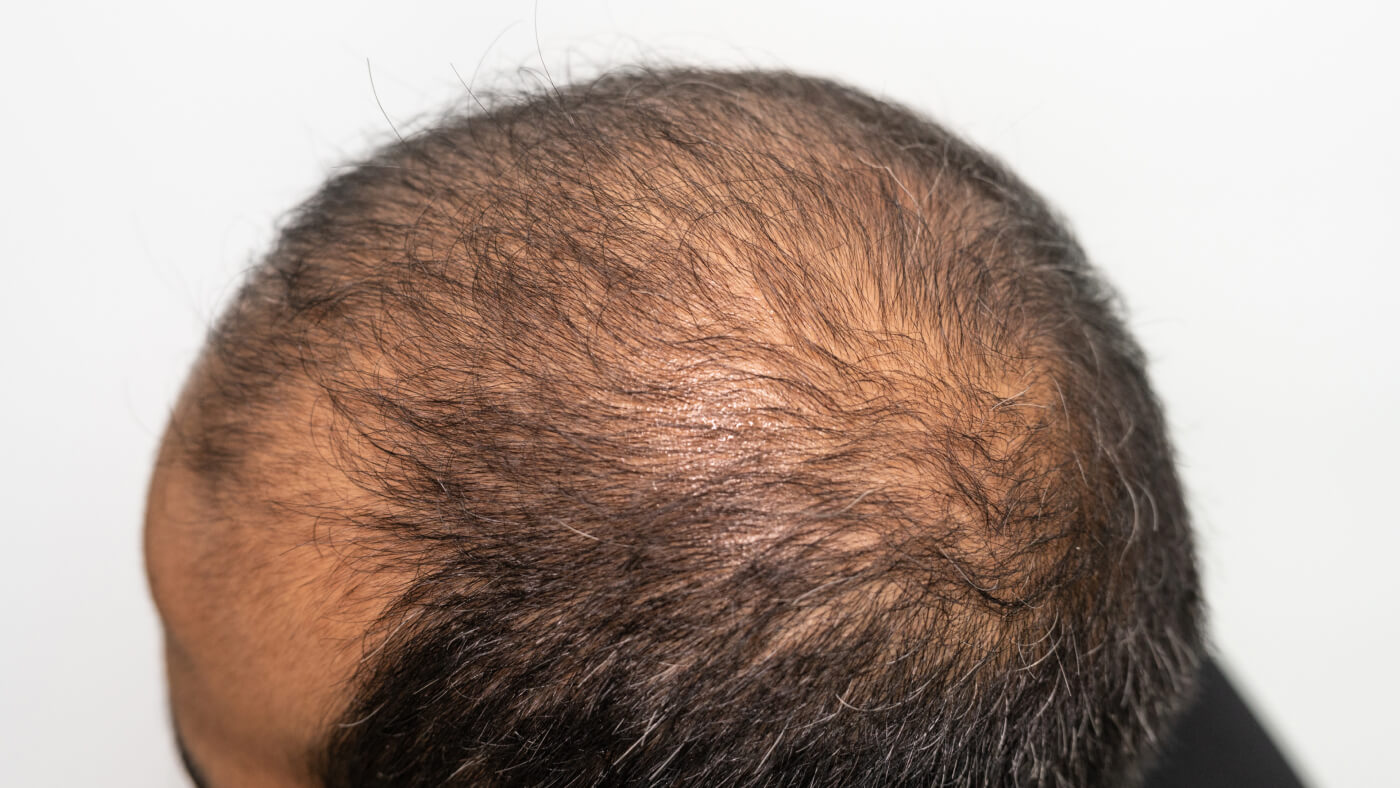 hair loss