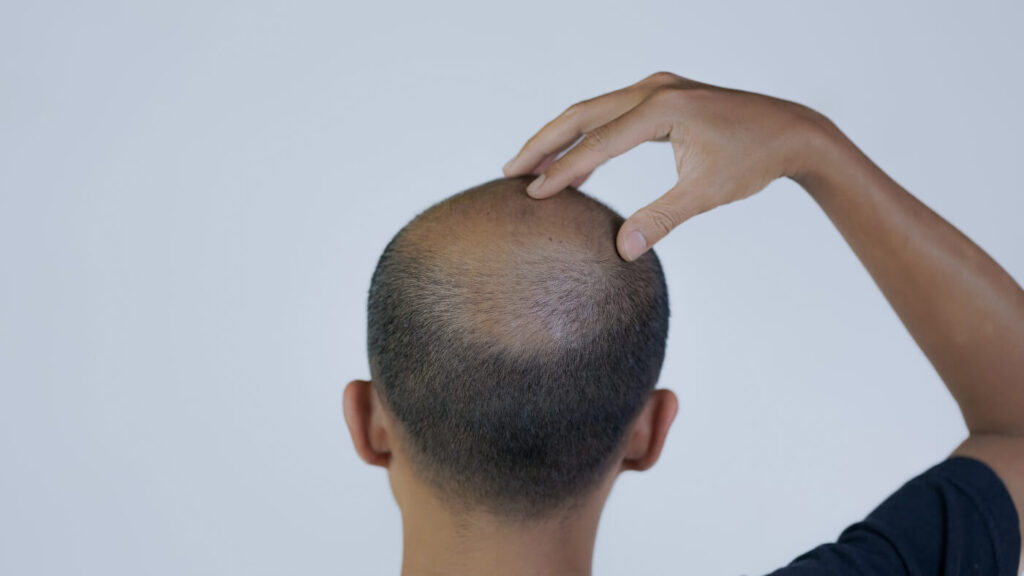 Hair Thinning | Faces By Bae | London Aesthetics | Award Winning