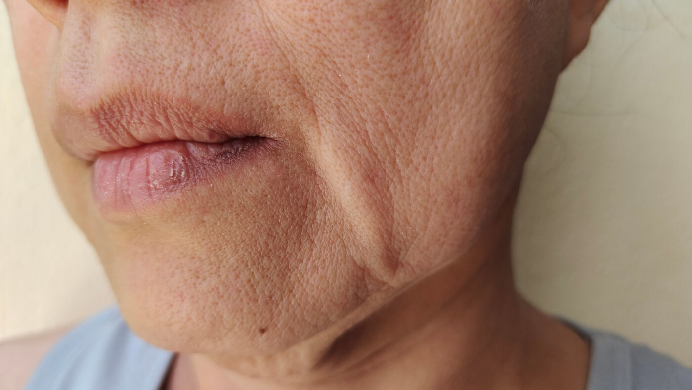 jowls treatment
