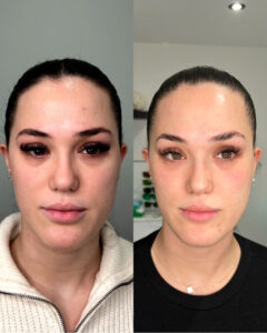 Lumi Eyes Before After