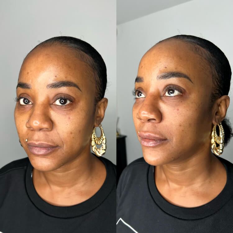 Nasolabial Fold Filler | Faces By Bae | London Aesthetics | Award Winning