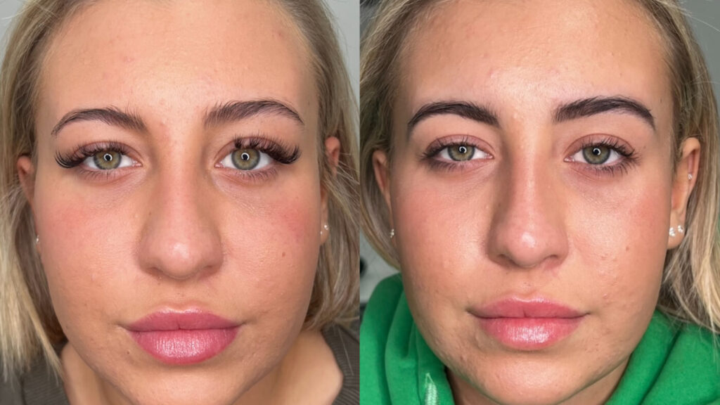 nostril flare reduction treatment