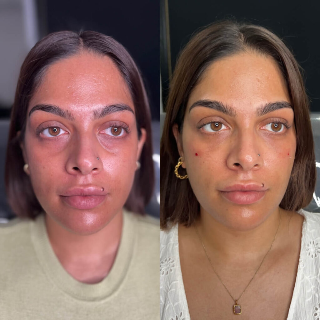 tear trough filler
