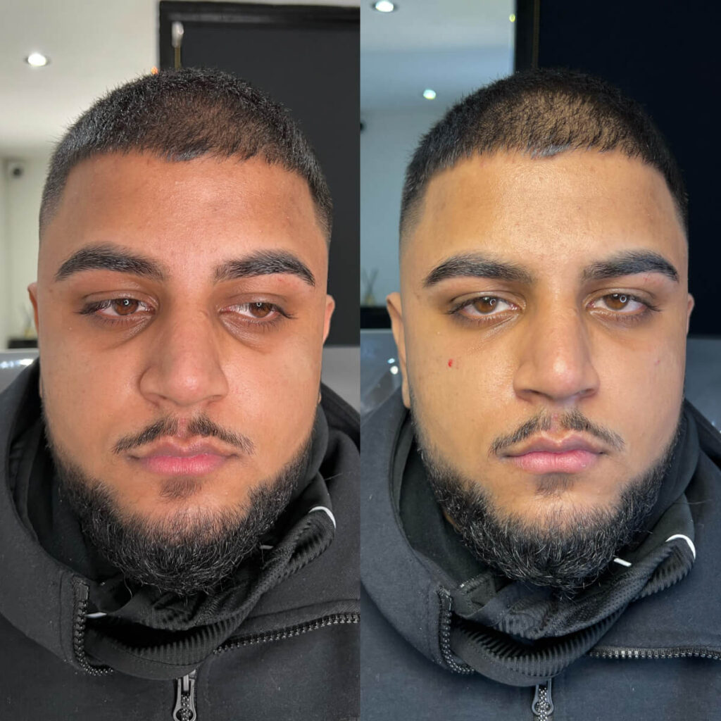 tear trough filler