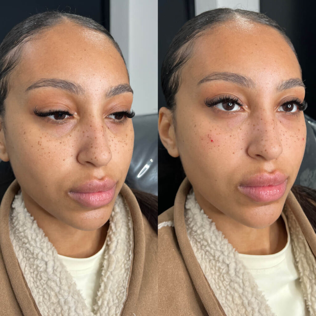 tear trough filler