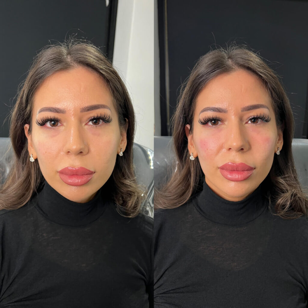 tear trough filler