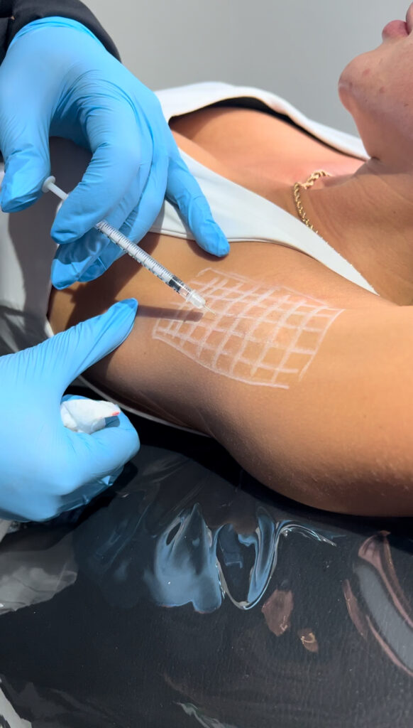 Underarm Sweating Reduction