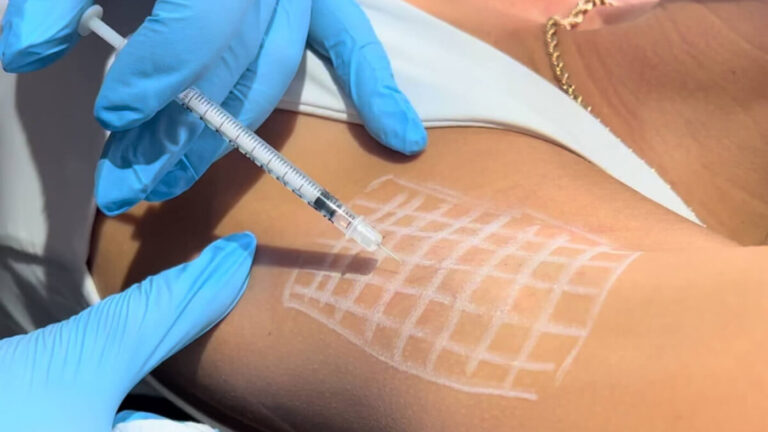 underarm sweating reduction
