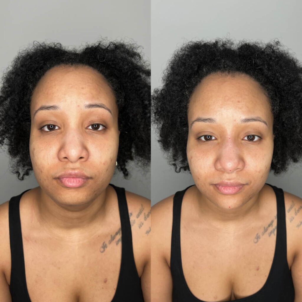 Chin Filler | Faces By Bae | London Aesthetics | Award Winning