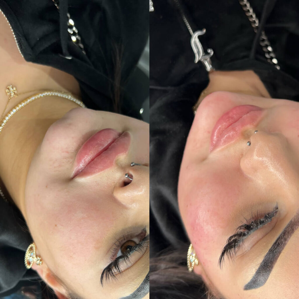 Chin Filler | Faces By Bae | London Aesthetics | Award Winning