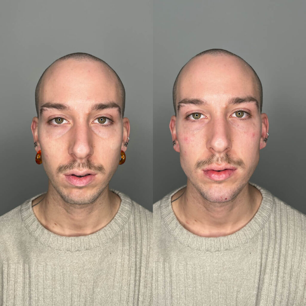 Chin Filler | Faces By Bae | London Aesthetics | Award Winning