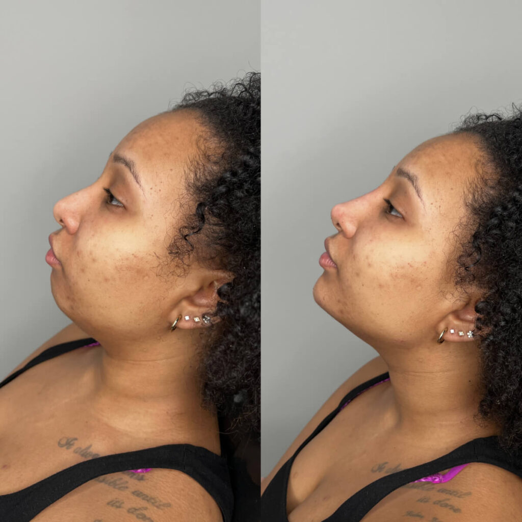 Chin Filler | Faces By Bae | London Aesthetics | Award Winning